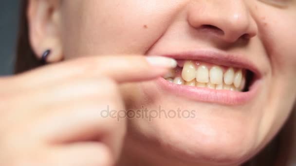 Chica señalando con los dedos herida después de la extracción dental — Vídeos de Stock