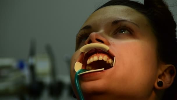 Οδοντίατρος τοποθετεί τα υποστηρίγματα στα δόντια του ασθενή (γυναίκα), ελέγχοντας με ο οδοντικός καθρέφτης και από τη διόρθωση με λέιζερ — Αρχείο Βίντεο