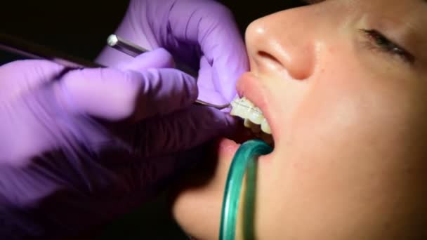 Стоматолог устанавливает фиксированную растяжку на зубах пациента — стоковое видео