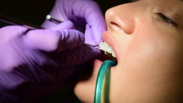 El dentista establece un estiramiento fijo a los dientes del paciente — Vídeo de stock