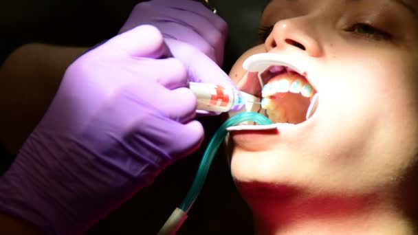 Размещение синего геля на зубах перед установкой скобок — стоковое видео