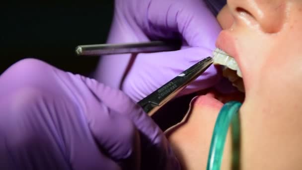 Las manos dentales girando alrededor del alambre en un aparato ortopédico, mujer joven en el consultorio dental — Vídeo de stock