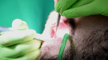 genç bir adamın ağzında diş hekimleri eller, genç adam oturma onun teeths dişçisi giderir iken, diş çürüğü diş sandalyeye temizliği