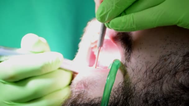 Zahnarzthände im Mund eines jungen Mannes, junger Mann sitzt auf Zahnarztstuhl, während sein Zahnarzt seine Zähne repariert, Zähne von Karies reinigt