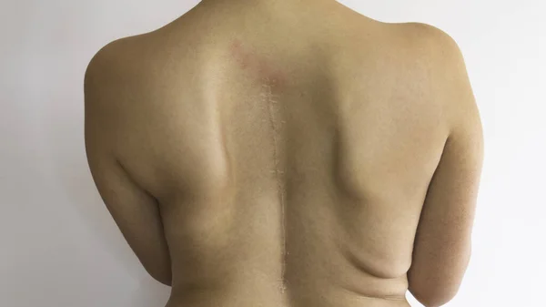 Costas Nuas Uma Mulher Com Cicatriz Cirurgia Coluna Vertebral Escoliose — Fotografia de Stock