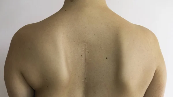 Una Vieja Cicatriz Espalda Una Joven Operado Nuevo Cirugía Columna —  Fotos de Stock