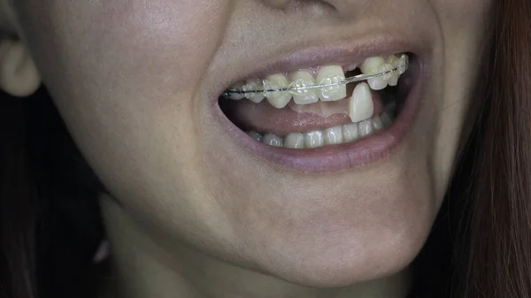 A woman\'s smile. Smile without upper left unit teeth. Tooth model with metal wire dental brace. Single Missing Tooth - Removable partial denture. One false plastic tooth.