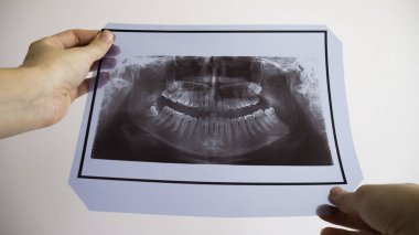 X-ray diş taraması yapan kadınların elleri. Diş teli ile üst dişler.