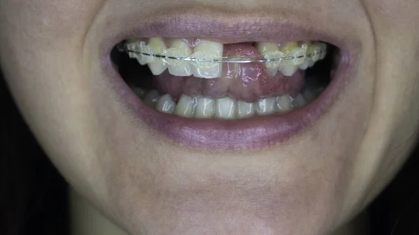 Sorria Uma Jovem Sem Dente Frente Modelo Dente Com Fio — Fotografia de Stock