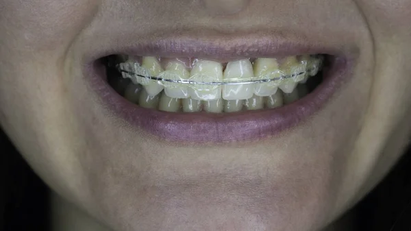 Sorriso Uma Jovem Mulher Usando Aparelho Dentário Close — Fotografia de Stock