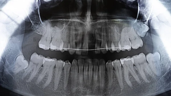 Оригинальное Рентгеновское Сканирование Зубов Верхние Зубы Зубными Скобами — стоковое фото