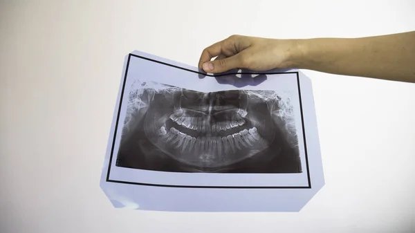 Ручной Рентген Зубов — стоковое фото