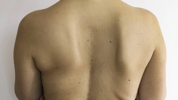 Escoliose Coluna Vertebral Mulher Curvada Voltou Com Uma Cicatriz Cirurgia — Fotografia de Stock