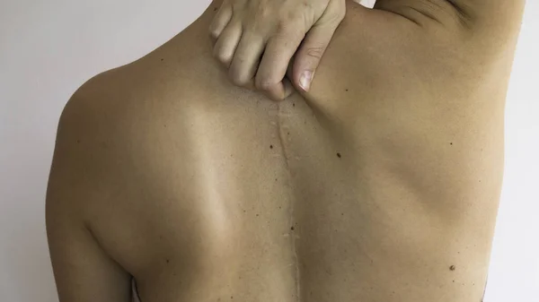 脊柱的结节病 后背有脊柱手术的疤痕 — 图库照片