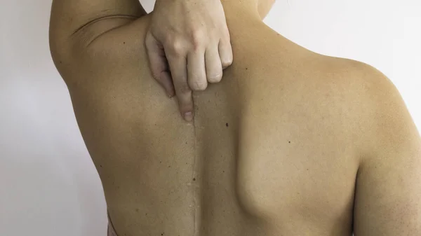Mulher Aponta Dedo Para Cicatriz Nas Costas — Fotografia de Stock