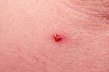Nevus insan derisinin altında asılı.