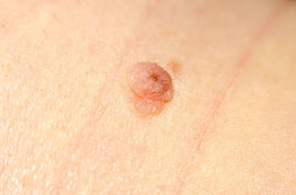 Nevus Grande Lunar Cuerpo Femenino Hombro — Foto de Stock