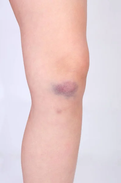 Bruise Knee Small Child Gray Background — ストック写真