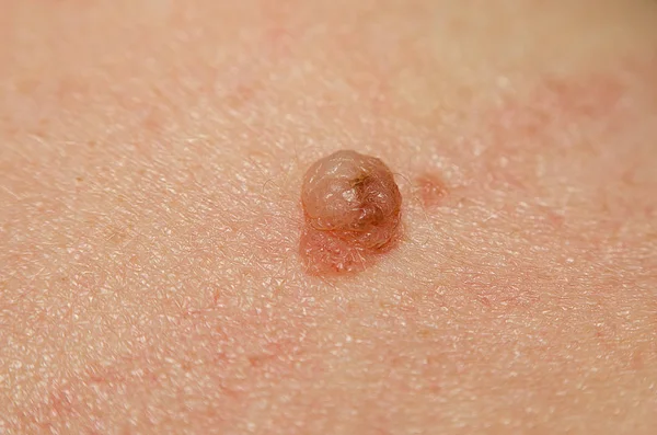 Nevus Pele Uma Mulher Close — Fotografia de Stock