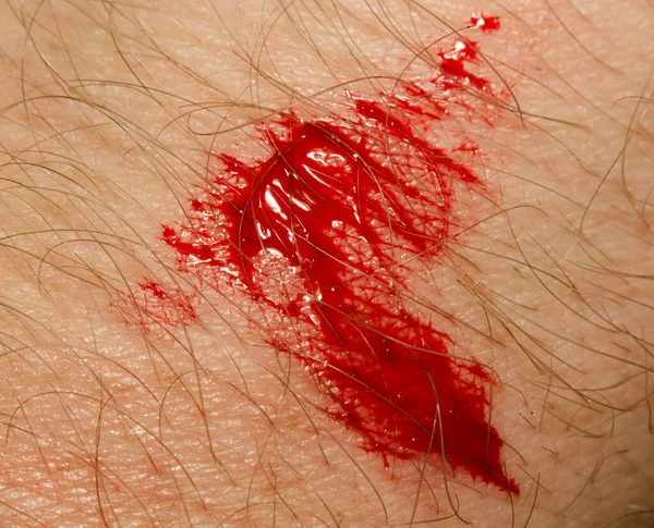 Sangue Pele Humana Close — Fotografia de Stock
