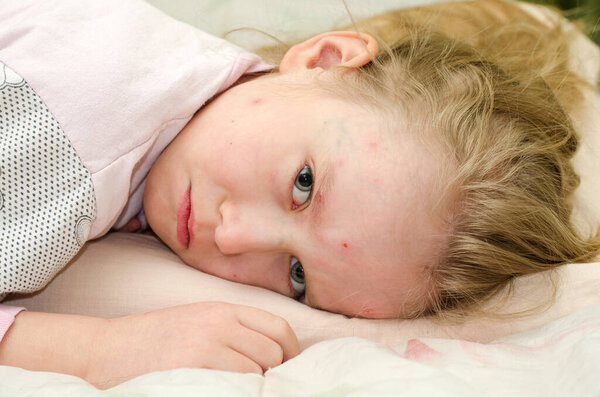 Little baby girl lies on a bed with chickenpox