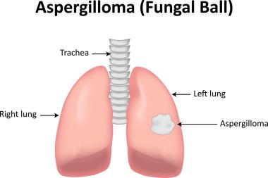 Aspergilloma Fungal Ball Infection in the Lungs clipart