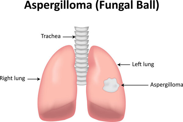 Aspergilloma Fungal Ball Infection in the Lungs