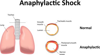 Anaphylactic Shock Illustration Lungs clipart