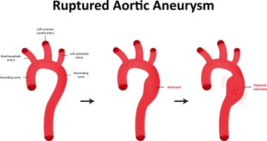 Ruptured Aortic Aneurysm Illustration clipart
