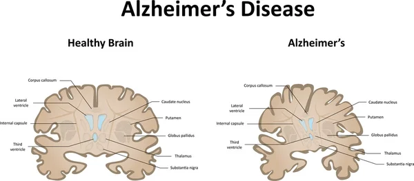 Alzheimers 질병의 두뇌와 모터 시스템 — 스톡 벡터