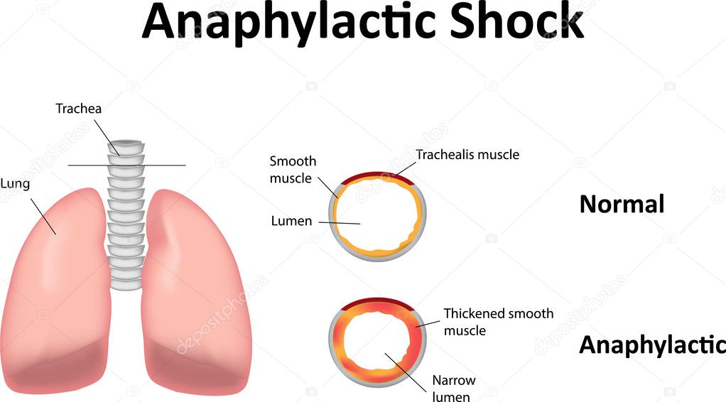 Anaphylactic Shock Illustration Lungs