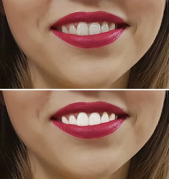 Smile teeth before and after — Stock Photo, Image