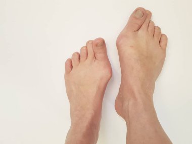 Hallux valgus, bacaklar, eklem ağrıyan beyaz üzerinde izole