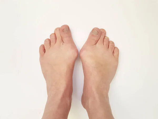 Hallux Valgus Füße Isoliert — Stockfoto