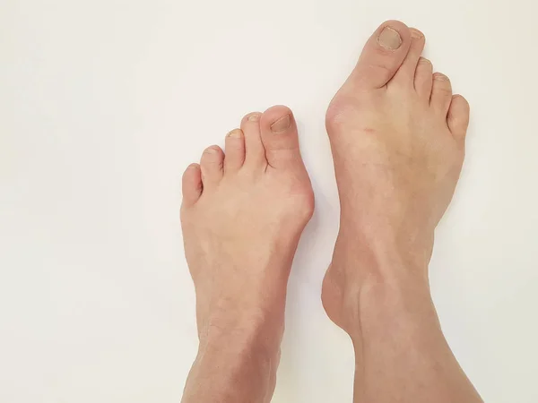 Hallux valgus, bacaklar, eklem ağrıyan beyaz üzerinde izole