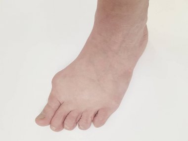 Halluks valgus, eklem ağrıyan beyaz üzerinde bacakları izole