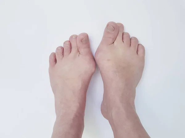 Hallux Valgus Beine Isoliert Auf Weiß Schmerzende Gelenke Vererbung — Stockfoto