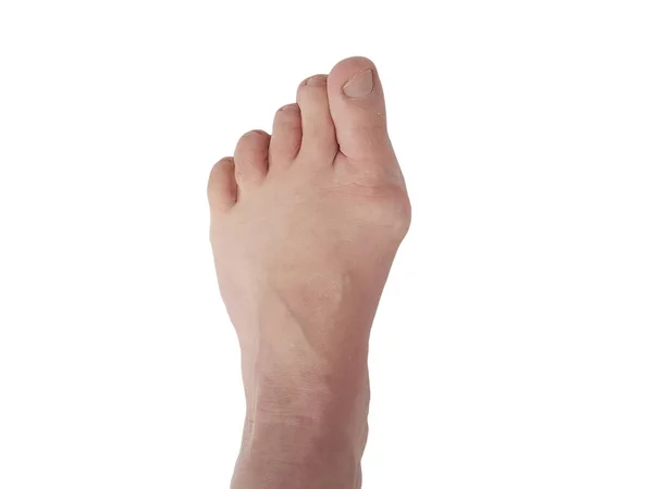 Halluks valgus, eklem ağrıyan beyaz üzerinde bacakları izole