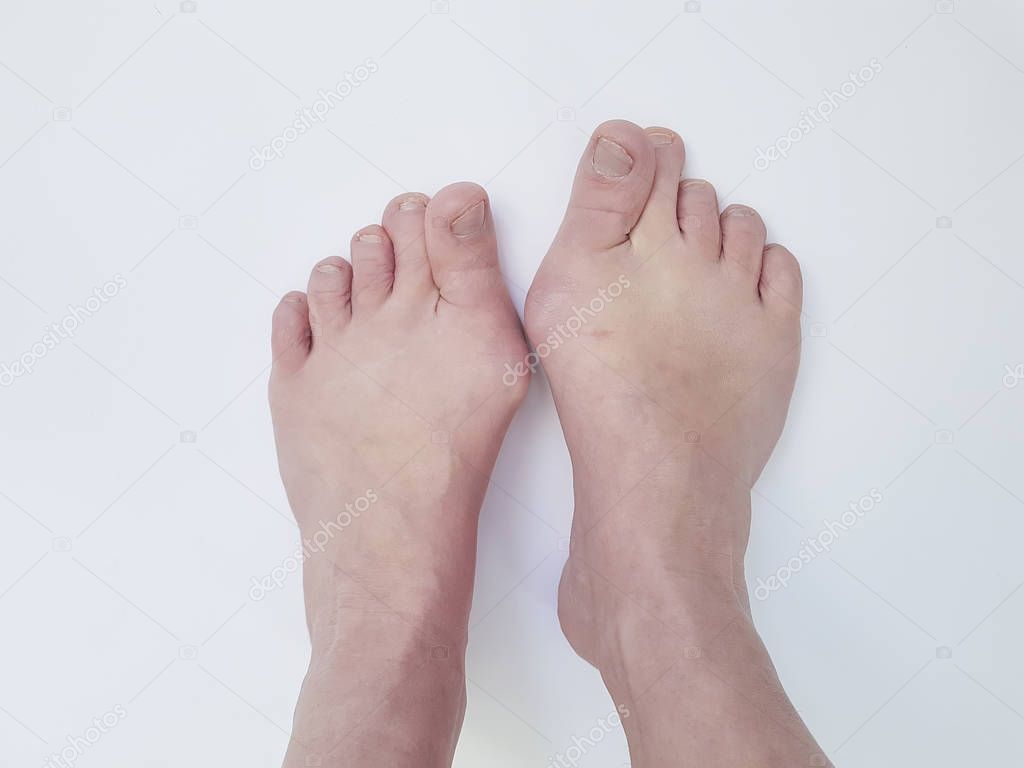 Hallux valgus, legs isolated on white, aching joints, heredity