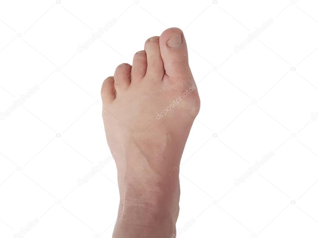 Hallux valgus, legs isolated on white, aching joints