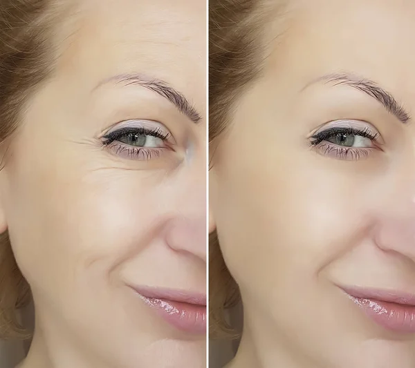 woman face wrinkles before and after