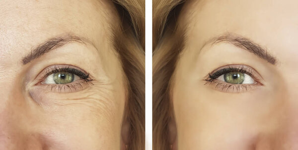 woman face wrinkles before and after