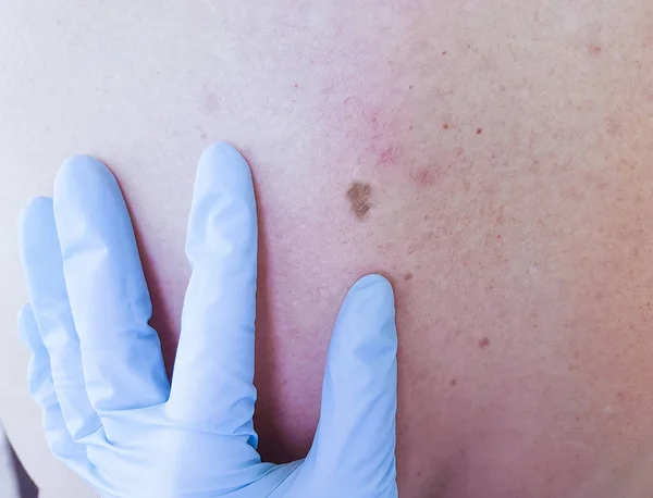Dermatologist Examines Patient Mole Back — Stock Photo, Image