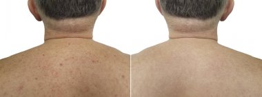 doğum lekesi sivilce arka erkekler kötü deri işlemden önce ve sonra