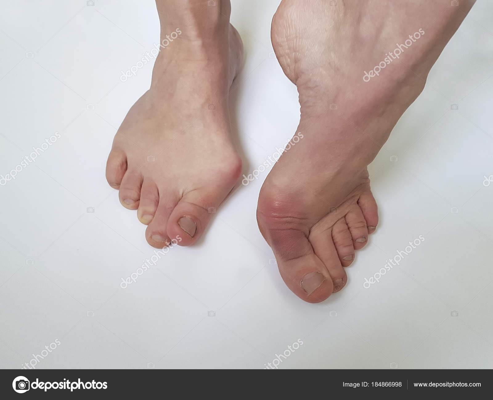 врожденная деформация стопы. деформация стопы видео. гимнастика при вальгусной деформации стопы у детей 2 года. деформация стопы видео. искривление пальцев ног.