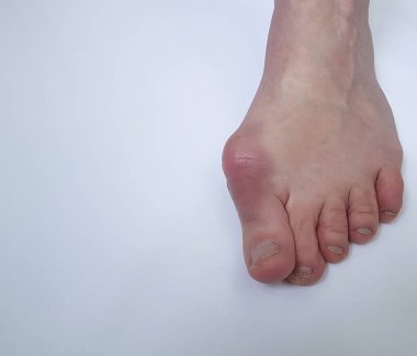 Beyaz bir arka plan üzerinde valgus kadın bacak
