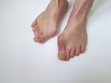 Beyaz bir arka plan üzerinde valgus kadın bacak