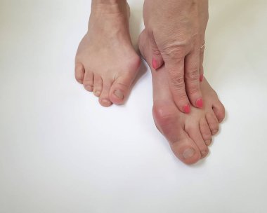 Beyaz bir arka plan üzerinde valgus kadın bacak