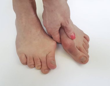 Beyaz bir arka plan üzerinde valgus kadın bacak