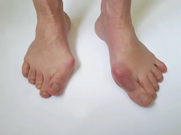 Beyaz bir arka plan üzerinde valgus kadın bacak